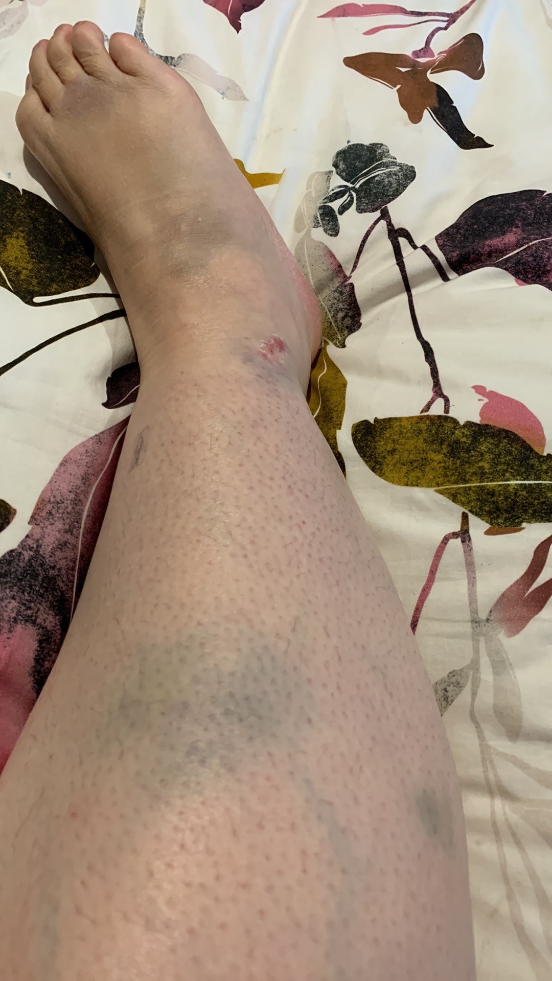 Injury & Yoga & Pilates
